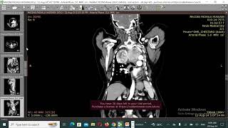 Carcinoid tumor of the lung [upl. by Dincolo454]