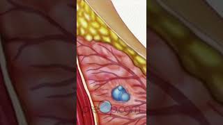 Understanding Breast Biopsy 🌸 Need to Know🎗️ BreastBiopsy PreOp Shorts PreOp Patient Education 2 [upl. by Wini198]