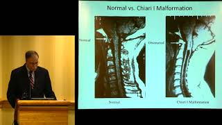 quotSyringomyelia Update Diagnosis Treatment and Researchquot  John D Heiss MD [upl. by Elamaj]