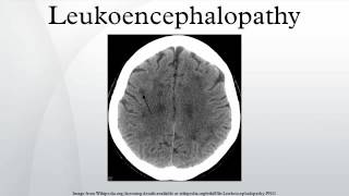 Leukoencephalopathy [upl. by Anyela]