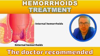 Hemorrhoids treatment [upl. by Marks]