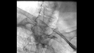 ANGIOPLASTIA COM IMPLANTE DE STENT PARA ARTÉRIA SUBCLÁVIA DIREITA [upl. by Nonaihr]