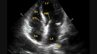 Mild Tricuspid Regurgitation With Borderline Pulmonary Hypertension [upl. by Drofxer]