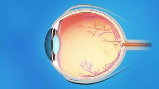 Understanding Glaucoma [upl. by Zaller]