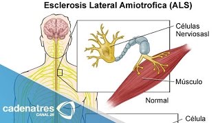 Neurólogos explican qué es la esclerosis lateral amiotrófica [upl. by Infield]