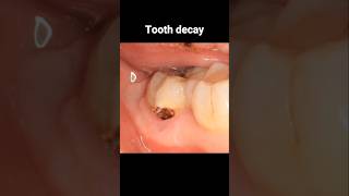 Filling tooth decay process dentistry dentist filling tooth [upl. by Agace665]