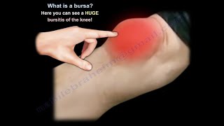 What Is BURSITIS  Everything You Need To Know  Dr Nabil Ebraheim [upl. by Annazus190]