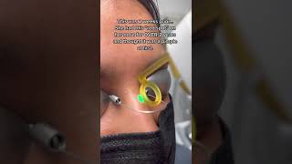 Laser for cherry angioma removal shorts redspot cherryangioma [upl. by Spear440]