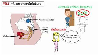 Painful Bladder Syndrome PBS  Interstitial Cystitis IC [upl. by Schroth]