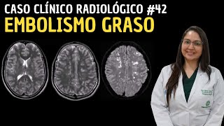 Caso Clínico Radiológico 42 Embolismo graso [upl. by Cade]