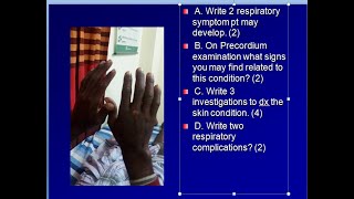 Systemic sclerosis [upl. by Eelrahs]