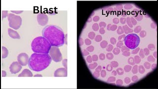 Lymphocyte or Blast   How do you tell the difference [upl. by Ruon]