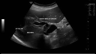 Abdominal Aortic Dissection doppler ultrasound [upl. by Ansev]