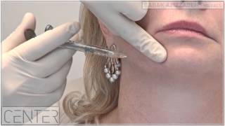 NonSurgical Jowl and Jawline Lift  Dr Babak Azizzadeh in Beverly Hills [upl. by Baptista]