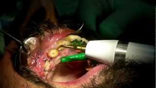 Estrazione di una radice dentale con Piezo Surgery [upl. by Kilan]