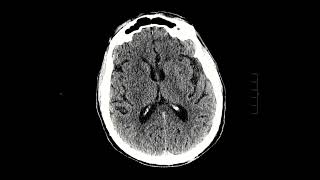 Acute right MCA stroke [upl. by Downe]