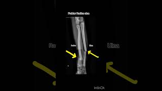 Fraktur Radius ulna xray radiology radius ulna patahtulang [upl. by Bonita525]