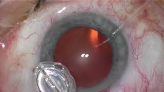 ZEPTO® Precision Cataract Surgery 360degree IOL Overlap Capsulotomy [upl. by Bathsheba]