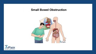 Small Bowel Obstruction [upl. by Rettuc]