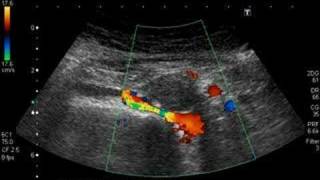 retroaortic left renal vein [upl. by Ion146]