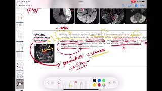 Neonatal intraventricular hemorrhage neurology 79  First Aid USMLE Step 1 in UrduHindi [upl. by Geesey929]