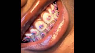 Teeth braces These are fashion bracesPrice N15000 explore jewelry [upl. by Ytnom]