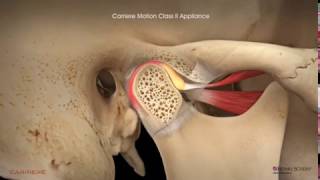 Carriere® Motion Clear™ Appliance with Clear Aligners Patient Education Animation [upl. by Adnilab880]