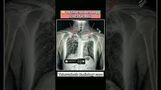 🩻How to Read TB Chest XRay😱 xray shorts viral chest radiology medical disease infection yt [upl. by Witty]