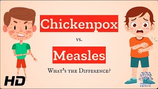 Chickenpox vs Measles Which is Which [upl. by Redneval13]