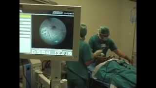 Intubation with Bonfils fiberscope under general anesthesia [upl. by Nahtnahoj]