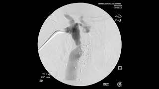 Management of CV Stenosis Endovascular vs Surgical Debate ASDIN 2023 [upl. by Dogs491]