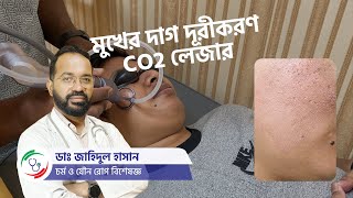 CO2 aser  Acne Scar Removal  Dr Zahidul Hasan [upl. by Attennod]