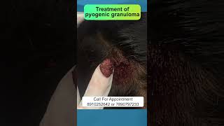 Treatment of pyogenic granuloma  By Dr Uttam Kumar Lenka MBBS MD Consultant Dermatologist [upl. by Gustave997]