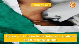 Session 115  Tuberculous Abscess in HIV patient [upl. by Samuella]