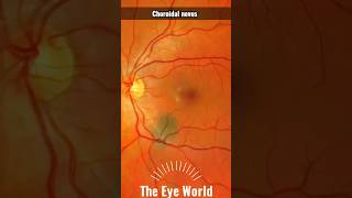 Choroidal nevus [upl. by Aurelius744]