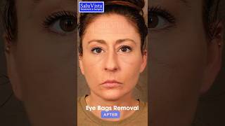 This is how we do eyelids or eyebags removal surgery eyebagsurgery bestplasticsurgeon turkey [upl. by Ahcsropal805]