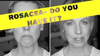 HOW TO KNOW IF YOU HAVE ROSACEA ⛔️ My 20 Year Journey from diagnosis to present day [upl. by Westhead]