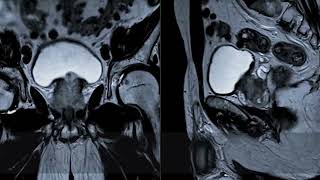 25 at 25 Improving prostate cancer diagnosis [upl. by Aicilana532]