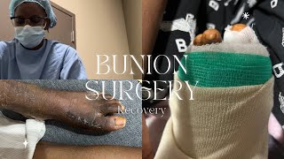 Bunion surgery recovery [upl. by Kaiulani636]