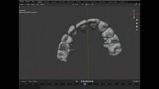 Simulation with extraction of the maxillary lateral incisors [upl. by Yseulte154]