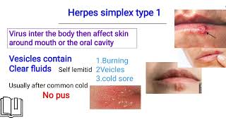 herpes simplex infection الهيربس [upl. by Hildebrandt871]