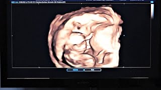 3D Ultrasound quotMeeting Our 17 Week Old Babyquot 17 Week Pregnancy Vlog 11 [upl. by Jones]