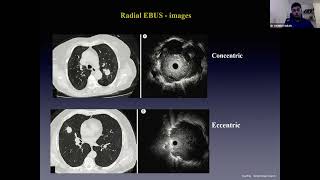 Interventional Pulmonology  Endobronchial Tuberculosis [upl. by Id921]