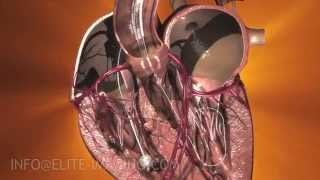 Heart Valve Implantation Full Procedure  Medical amp Scientific Video Production [upl. by Naffets]