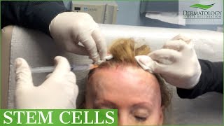 PRP  STEM CELLS for Female Hair Loss  Los Angeles  Dr Ben Behnam [upl. by Ailima50]