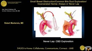 Common bile duct exploration Never laparoscopically [upl. by Dreeda426]