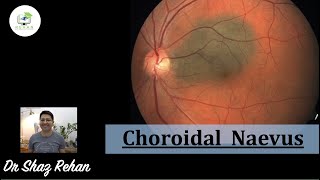 Choroidal Naevus What is it How is it Diagnosed Treatment What Else Could it be I Rehan 2021 [upl. by Assert]