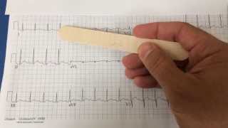 pericarditis on EKG [upl. by Siffre]