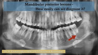 Mandibular posterior lesions  How easily can we diagnose it [upl. by Lathrope]