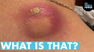 WHAT IS THAT Dr Lee Pops Satisfying Back Cyst  Dr Pimple Popper Reacts [upl. by Llednahs]